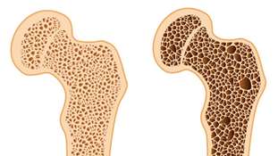 روز شمار هفته ملی سلامت استخوان/ پوسترها